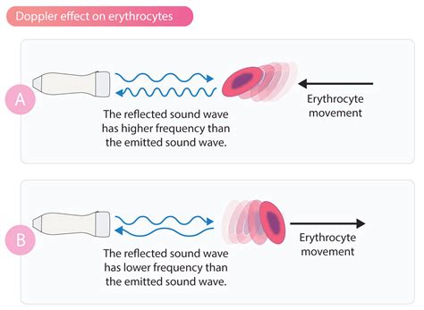 Doppler effect and Doppler echocardiography – .